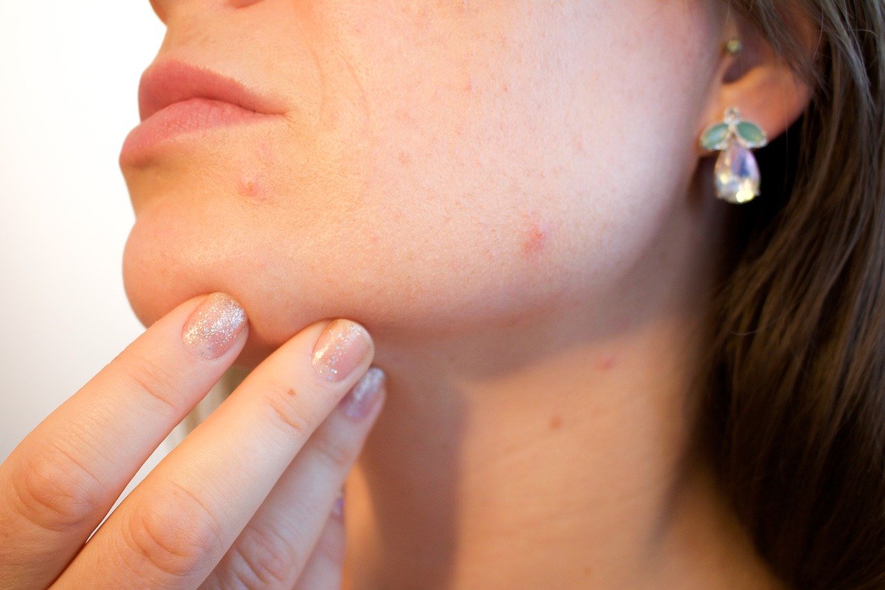 Maskne treatment may not be very difficult. Here are some tips.